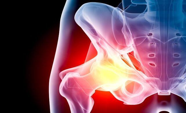 Arthrosis of the hip joint