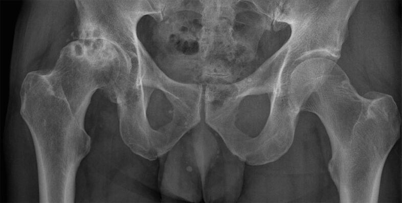 Deformed arthrosis of the hip joint on X-ray