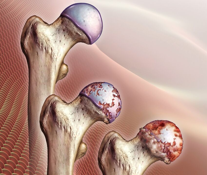 Development of hip joint arthrosis