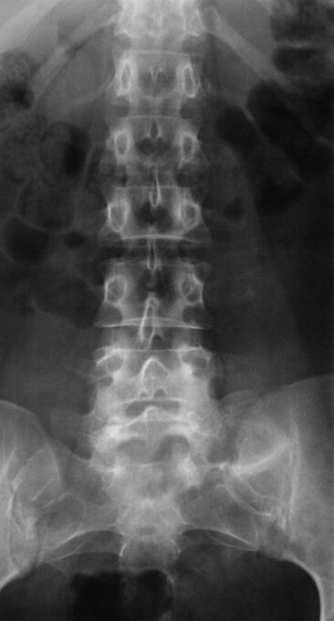 Radiography is performed to diagnose lumbar osteochondrosis