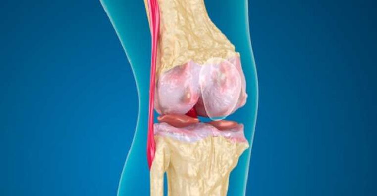 Arthrosis of the knee joint disease, which causes the joints to destroy the cartilage