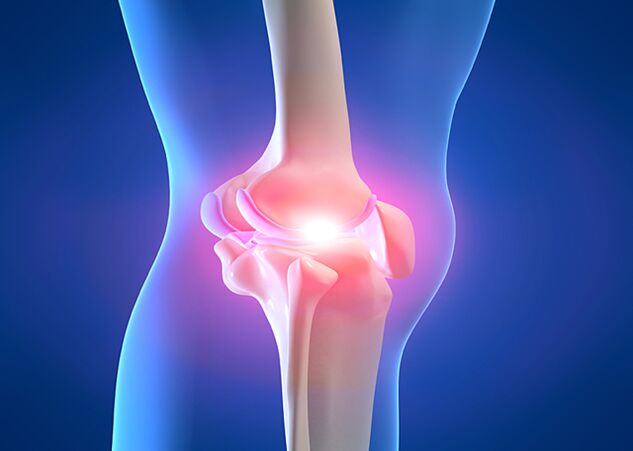 Joint pain due to knee arthrosis