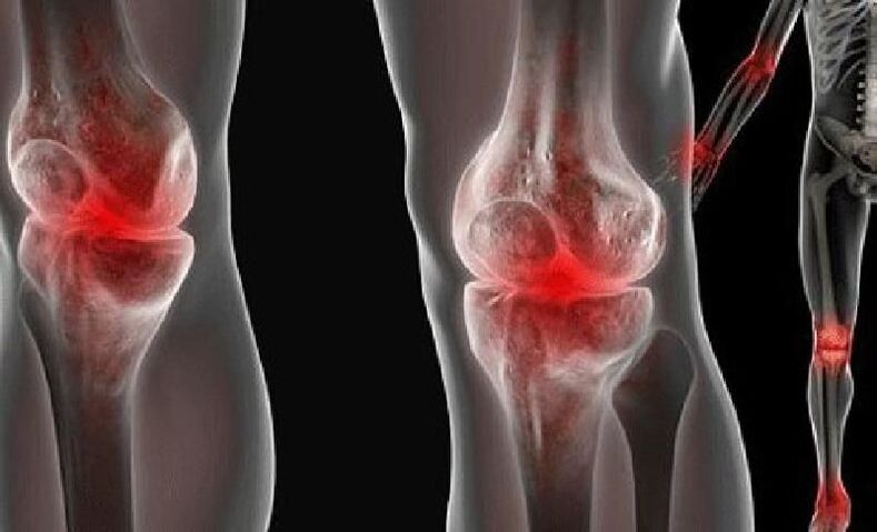 Symptoms of gonarthrosis of the joints