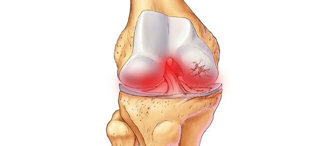 What does gonarthrosis of the knee joint look like