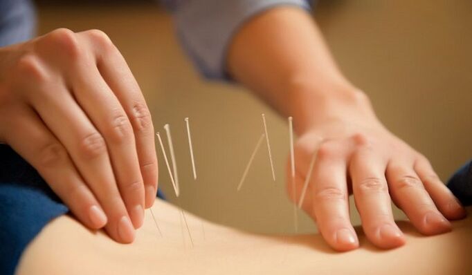 Acupuncture for lower back pain