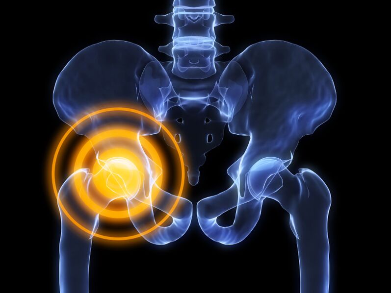 Arthrosis of the hip joint