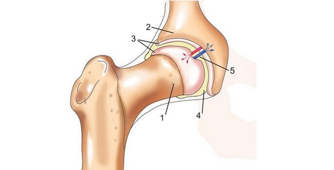Hip joint and arthrosis
